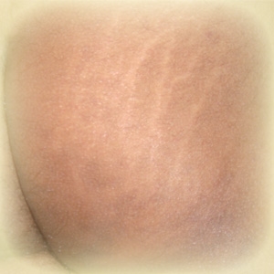 Stretch Marks On The Stomach After Pregnancy