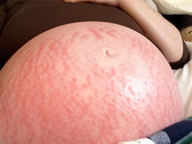 How To Fade Away Stretch Marks