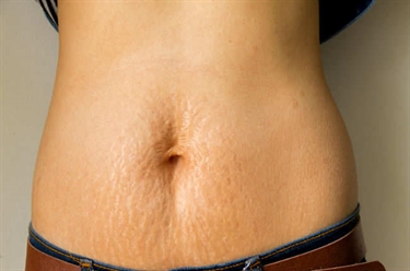 How To Avoid Stretch Marks In Pregnancy