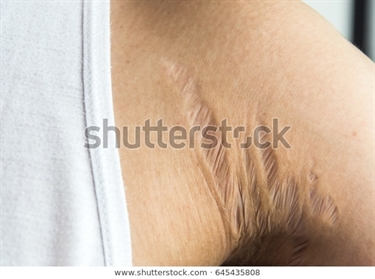 My Fourth Pregnancy And Im Getting For First Time Bad Stretch Marks What To Use