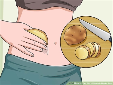 Cream For Stretch Marks After Pregnancy Philippines