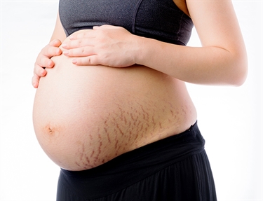 How To Clear Stretch Marks