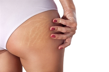White Stretch Marks Before And After