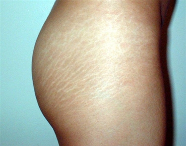 How Yo Get Rid Of Stretch Marks
