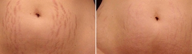 How To Fade Scars Naturally