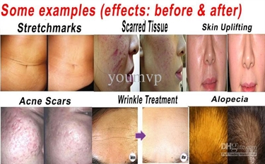 How To Reduce Stretch Marks On Stomach
