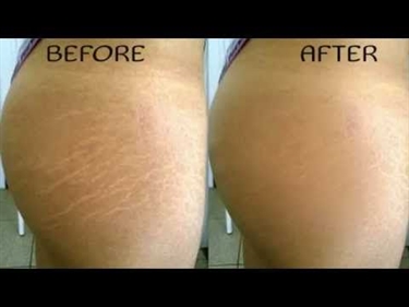 Stretch Mark Before After
