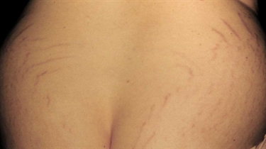 Silver Colored Striae