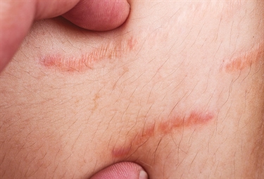 How Soon Do You Start Getting Stretch Marks During Pregnancy