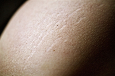 Natural Ways To Avoid Getting Stretch Marks During Pregnancy