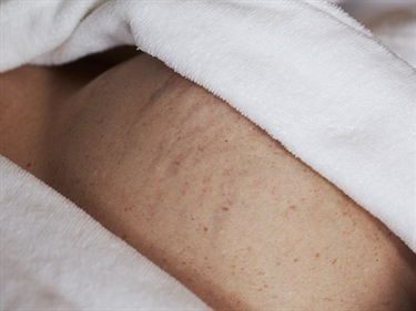 How Do U Get Stretch Marks