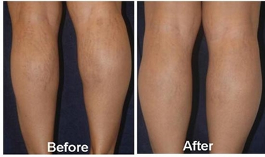 What Can I Use To Get Rid Of Stretch Marks