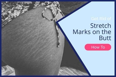 Is It Normal To Get Stretch Marks From Working Out