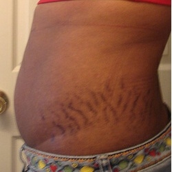 Back Stretch Marks From Growing