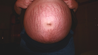 Can Exercise Prevent Stretch Marks During Pregnancy