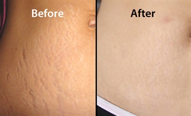 Why Are Stretch Marks Itchy