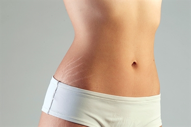 Stretch Marks Early Pregnancy