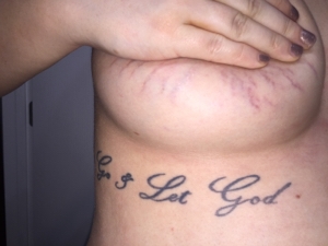 Extreme Stretch Marks After Pregnancy