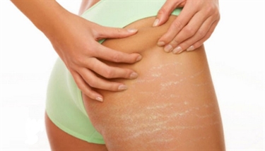 Stretch Mark Medical Term
