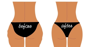 Get Rid Of Stretch Marks In 2 Weeks