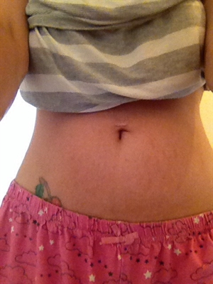 How To Get Stretch Marks