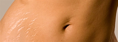 Stretch Marks From Pregnancy Before And After