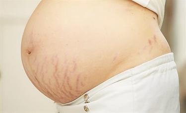 Pregnancy Reduce Stretch Marks
