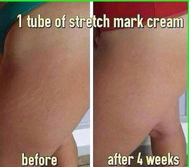 Does Mederma Stretch Mark Therapy Work