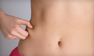 Why Do You Get Stretch Marks After Pregnancy