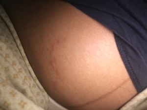 How To Reduce The Look Of Stretch Marks
