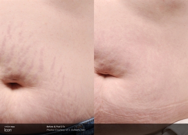 How To Get Rid Of Stretch Marks On Your Sides
