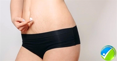 Remove Stretch Mark Cream
