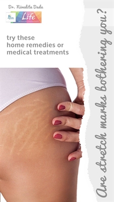 Pregnancy Stretch Marks Compared To Females In Family