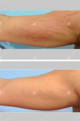 Dermalmd Stretch Mark Serum Reviews