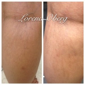 Faded Pregnancy Stretch Marks