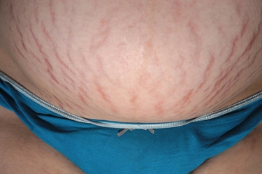 What Are The Causes Of Stretch Mark