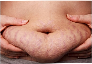 Best Anti Stretch Marks Cream For Pregnancy