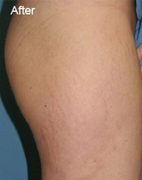 Olive Oil Pregnancy Stretch Marks