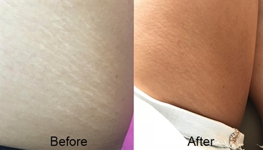 Old Stretch Marks During Pregnancy