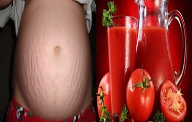Can You Prevent Stretch Marks With Pregnancy