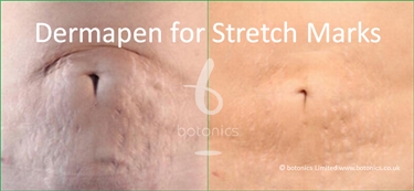 Female Post Pregnancy Stretch Marks