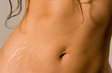 How Stretch Marks Happen