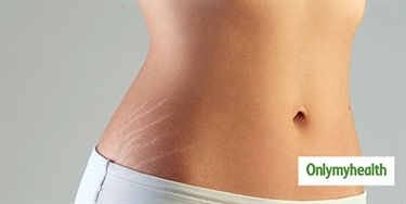 Stretch Mark Color