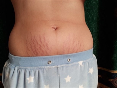 How Did I Get Stretch Marks