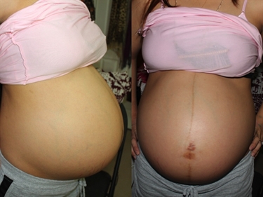 C Section Cream