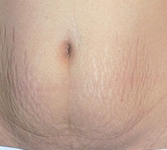 Avoid Stretch Marks Pregnancy