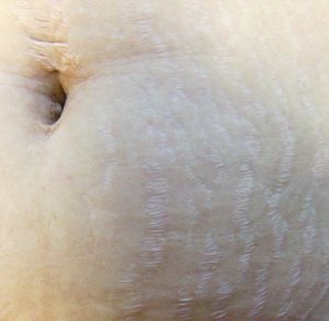 How To Prevent Stretch Marks During Pregnancy Naturally
