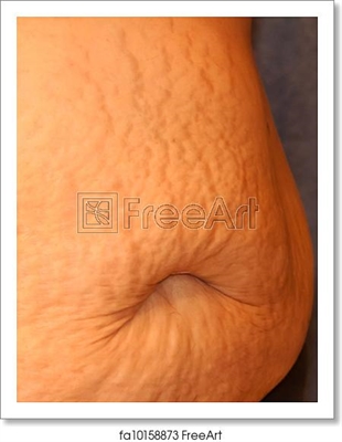 Making Stretch Marks Less Visible