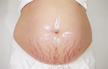 Why Did I Get Stretch Marks Everywhere During Pregnancy