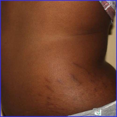When To Use Stretch Mark Cream